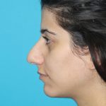 Rhinoplasty Before & After Patient #2106