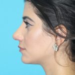 Rhinoplasty Before & After Patient #2106