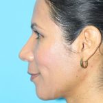 Rhinoplasty Before & After Patient #2127