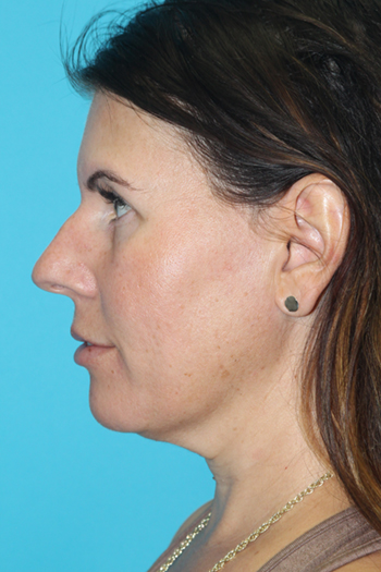 Rhinoplasty Before & After Patient #2134