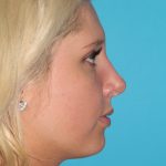 Rhinoplasty Before & After Patient #2141