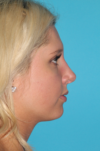 Rhinoplasty Before & After Patient #2141
