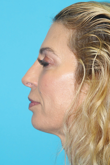 Rhinoplasty Before & After Patient #2097