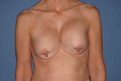 Breast Deformity Correction Before & After Patient #2199