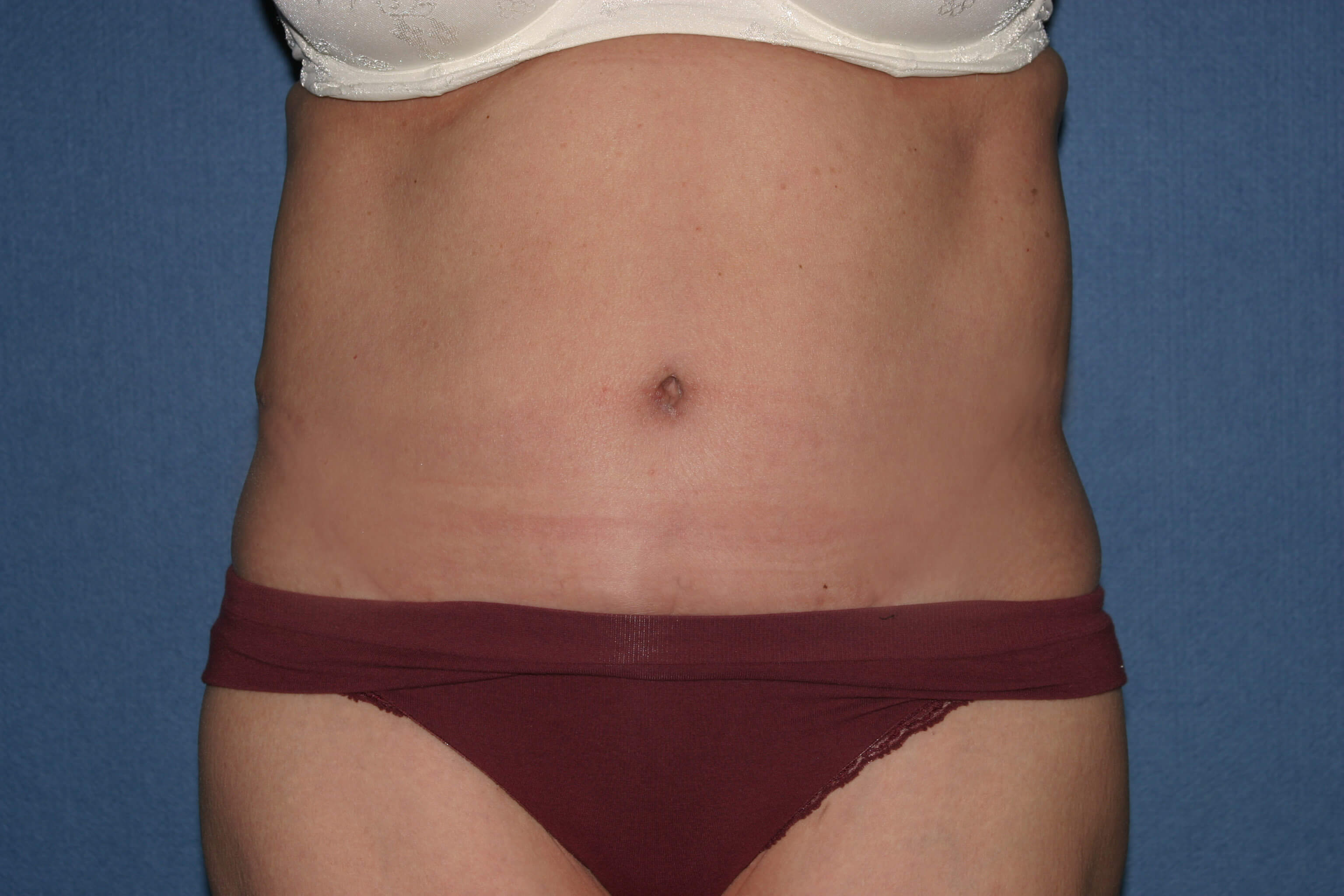 Body Lift Before & After Patient #2174