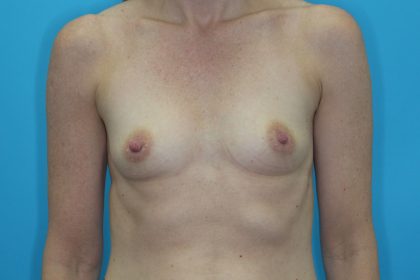Breast Lift with Augmentation Before & After Patient #2250