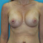 Breast Lift with Augmentation Before & After Patient #2250