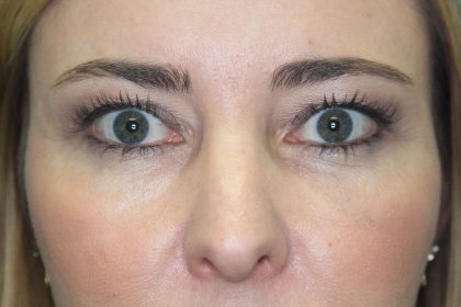 Eyelid Before & After Patient #2245
