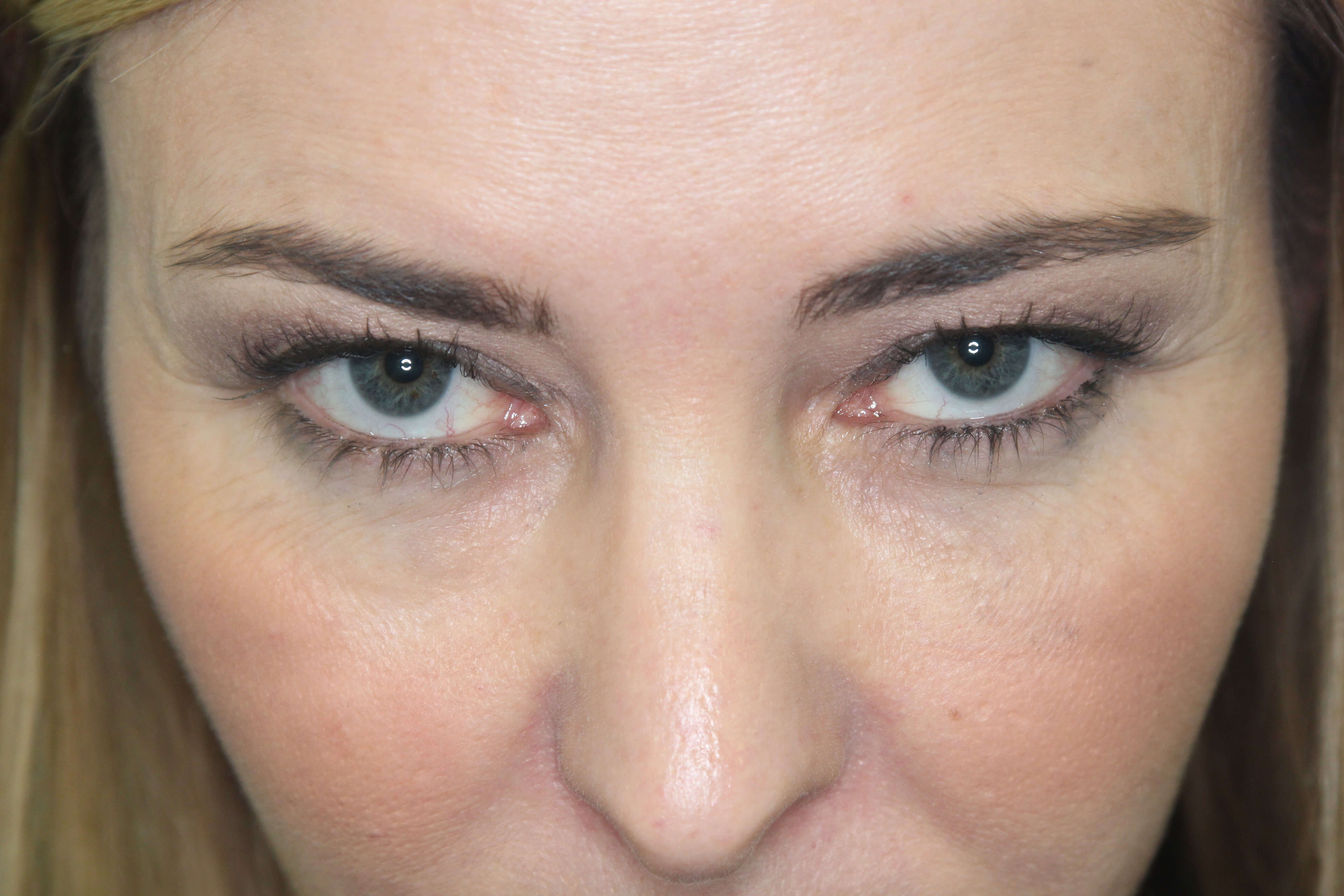 Eyelid Before & After Patient #2245