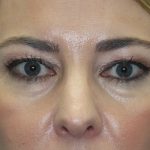 Eyelid Before & After Patient #2245