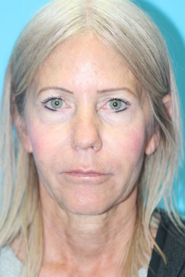 Croton Peel Before & After Patient #2485