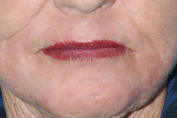 Croton Peel Before & After Patient #2459