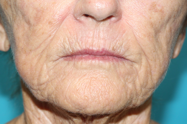 Croton Peel Before & After Patient #2459