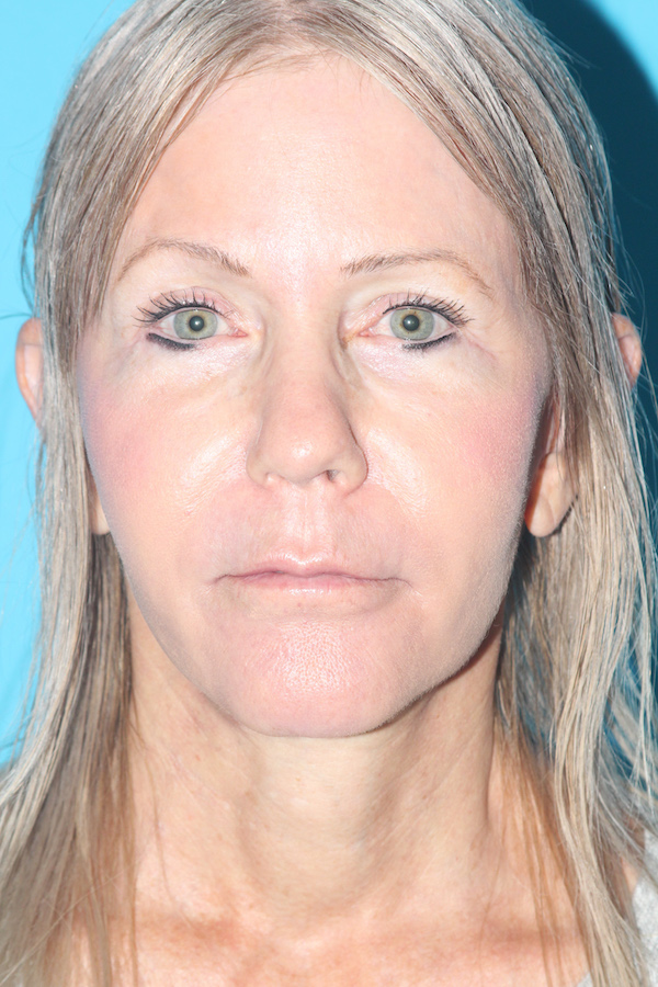 Croton Peel Before & After Patient #2485