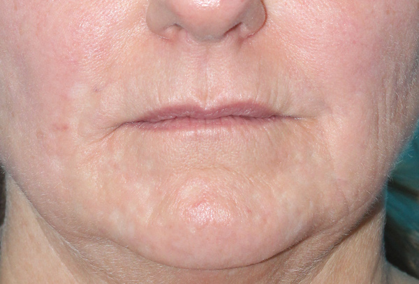 Croton Peel Before & After Patient #2456