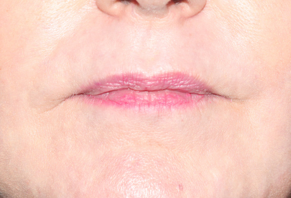 Croton Peel Before & After Patient #2456