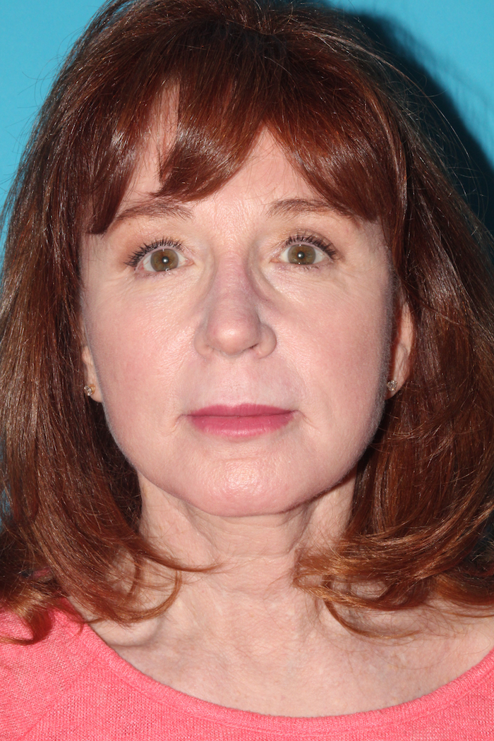 Facelift Before & After Patient #2495