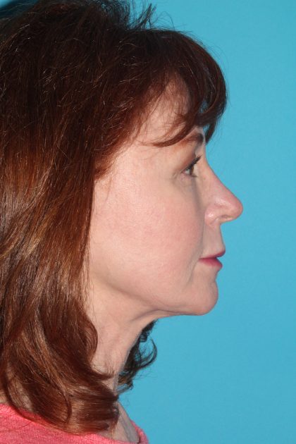 Facelift Before & After Patient #2495