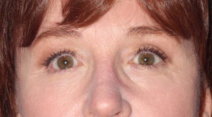 Eyelids and Periorbital Fat Before & After Patient #2490