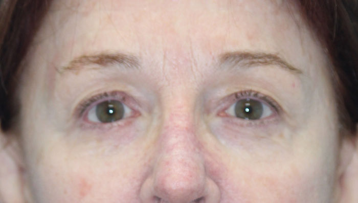 Eyelids and Periorbital Fat Before & After Patient #2490