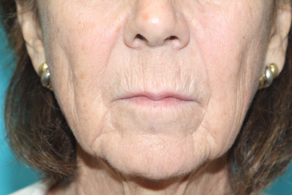 Croton Peel Before & After Patient #2476