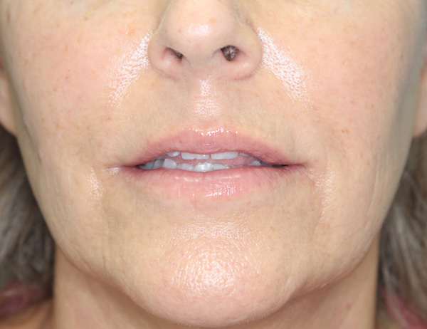 Croton Peel Before & After Patient #2482