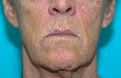 Croton Peel Before & After Patient #2470