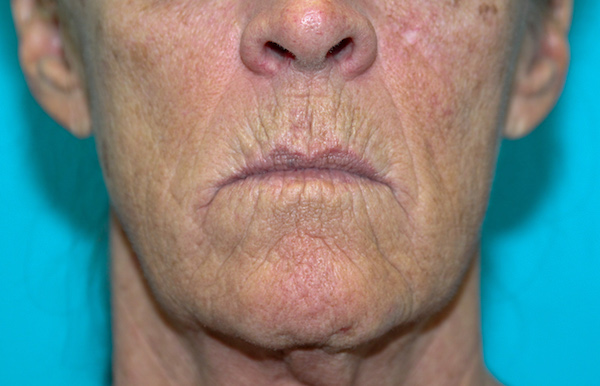 Croton Peel Before & After Patient #2470