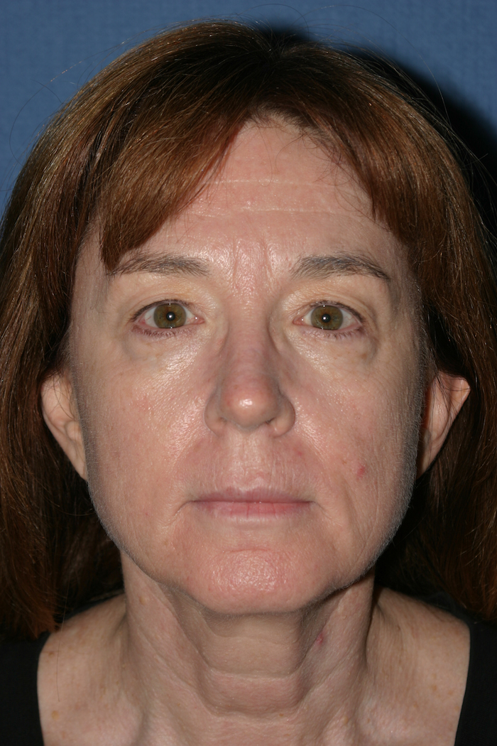 Facelift Before & After Patient #2495
