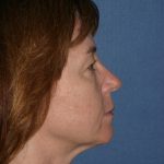 Facelift Before & After Patient #2495