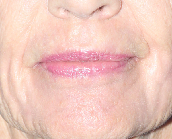 Croton Peel Before & After Patient #2479