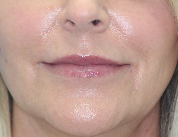Croton Peel Before & After Patient #2482