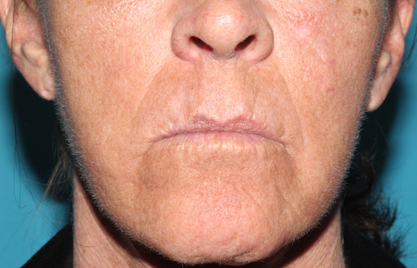 Croton Peel Before & After Patient #2470