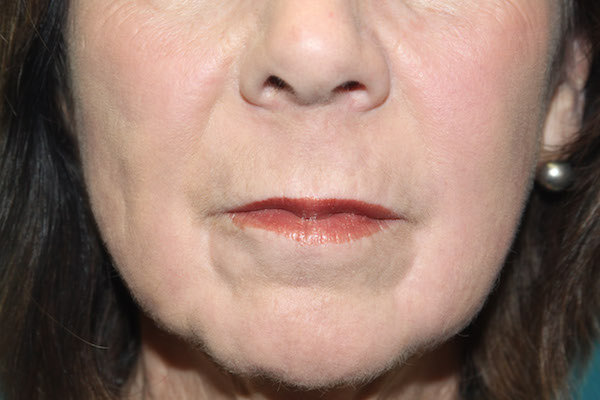 Croton Peel Before & After Patient #2476