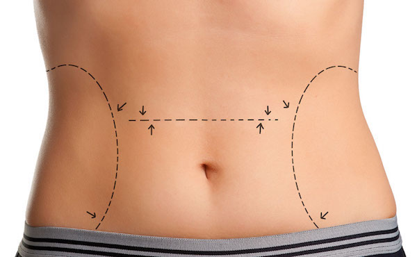 Best Plus Size Tummy Tuck® Scottsdale