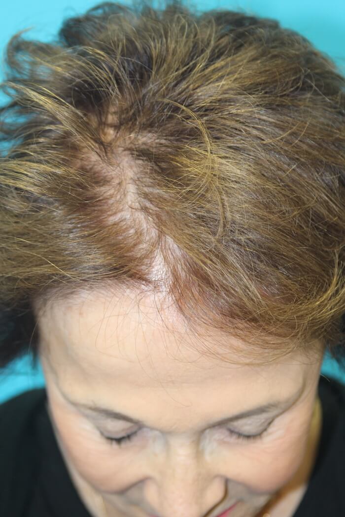 Neograft Before & After Patient #2598