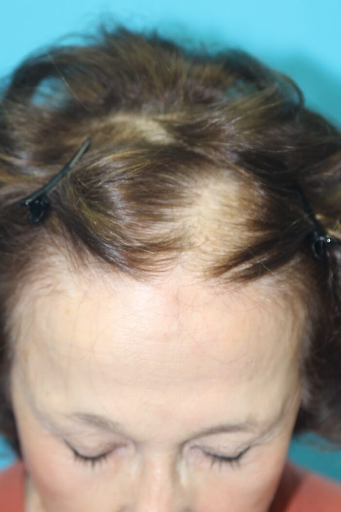 Neograft Before & After Patient #2598