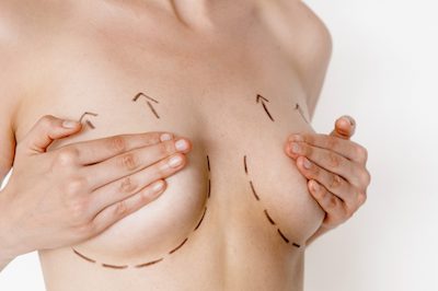 Candidates for Breast Lift 