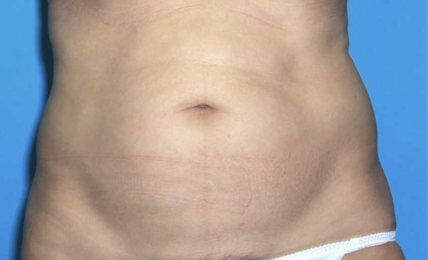 Power Assisted Liposuction Before & After Patient #3026