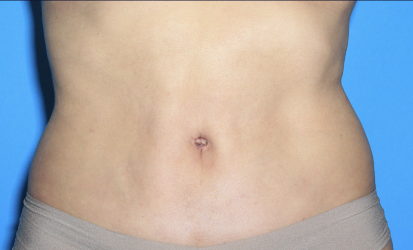 Power Assisted Liposuction Before & After Patient #3026