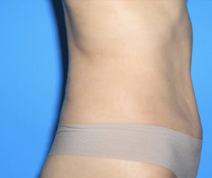 Tummy Tuck (Lipoabdominoplasty) Before & After Patient #3011