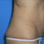 Tummy Tuck (Lipoabdominoplasty) Before & After Patient #3011