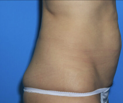 Power Assisted Liposuction Before & After Patient #3026