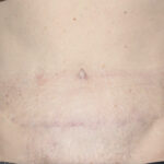 Tummy Tuck (Lipoabdominoplasty) Before & After Patient #3029