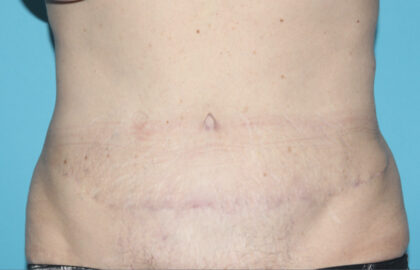 Power Assisted Liposuction Before & After Patient #3030