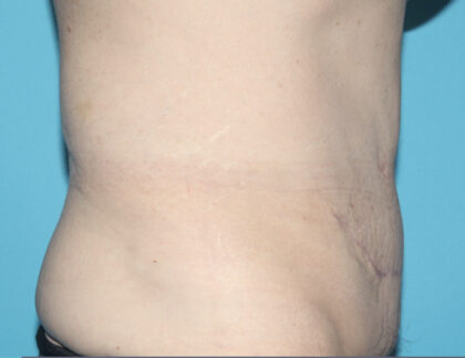 Tummy Tuck (Lipoabdominoplasty) Before & After Patient #3029