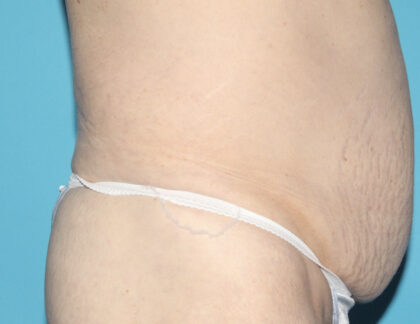 Power Assisted Liposuction Before & After Patient #3030