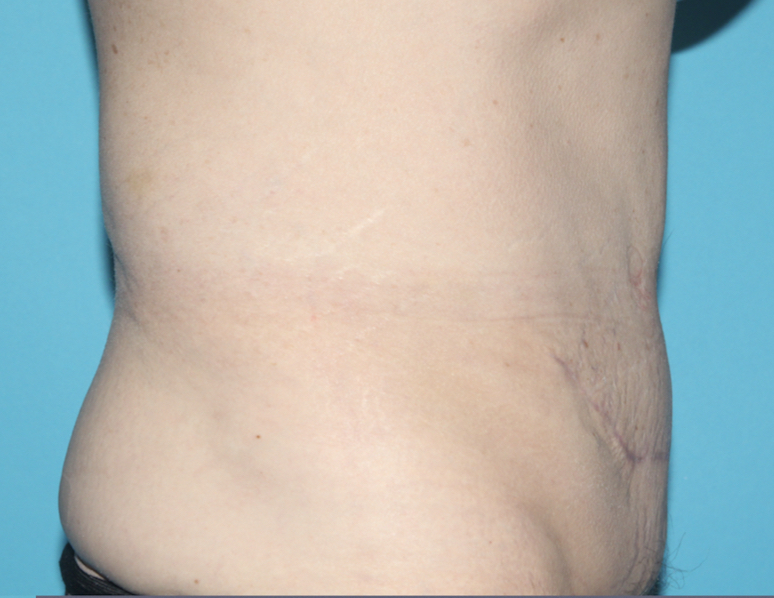 Power Assisted Liposuction Before & After Patient #3030