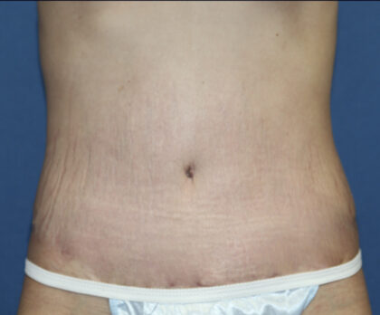 Tummy Tuck (Lipoabdominoplasty) Before & After Patient #3027
