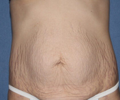 Tummy Tuck (Lipoabdominoplasty) Before & After Patient #3027